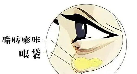 眼袋
