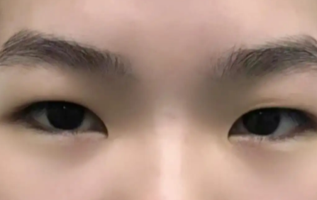 超声波双眼皮