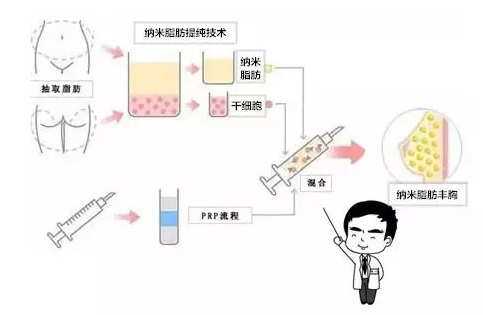 自体脂肪细胞丰胸