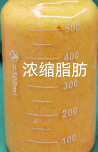 自体脂肪细胞丰胸