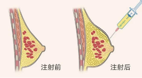 自体脂肪细胞丰胸