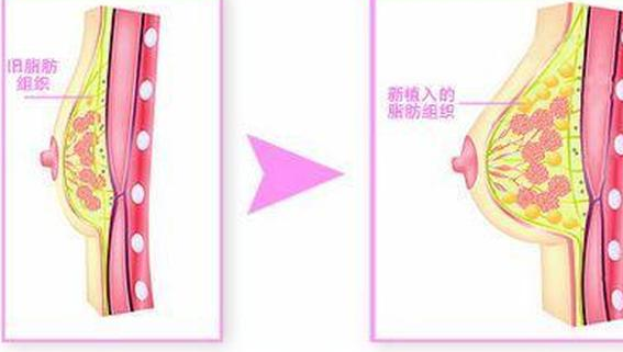 自体脂肪细胞丰胸