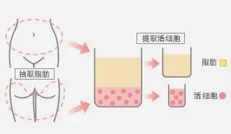自体脂肪细胞丰胸