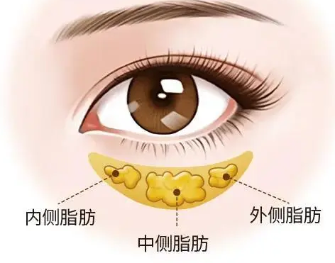 眼袋