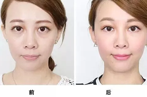 眼袋