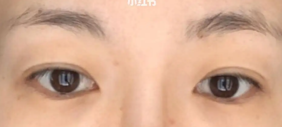 眼袋
