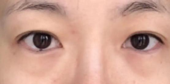 眼袋