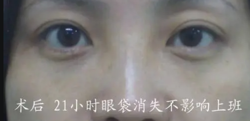 眼袋