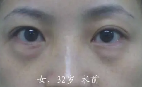 眼袋