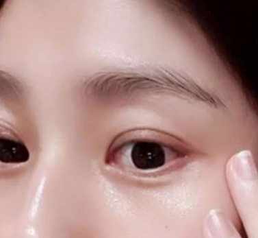 眼袋
