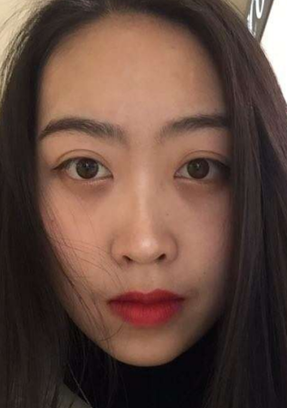 眼袋