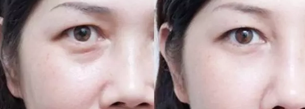 眼袋