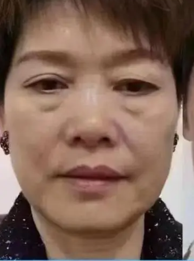 眼袋