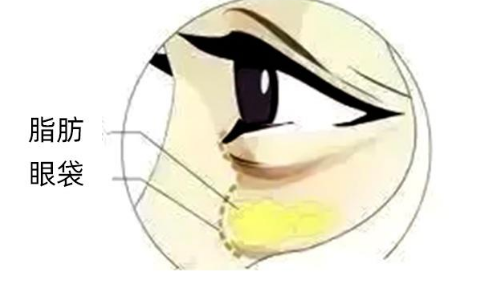 眼袋