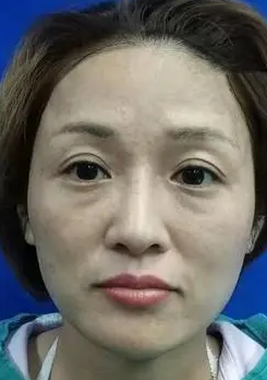 眼袋