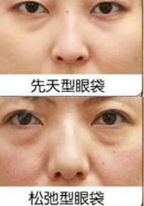 眼袋