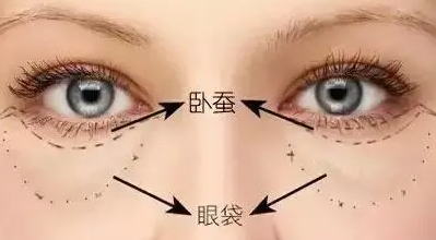 眼袋