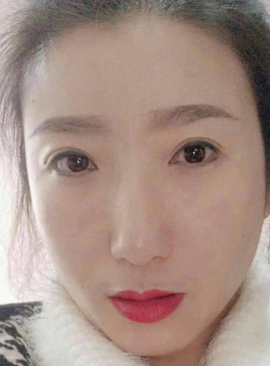 眼袋