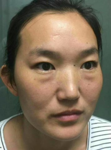 眼袋