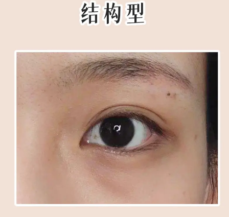 眼袋