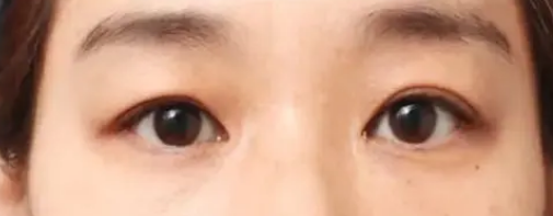 眼袋