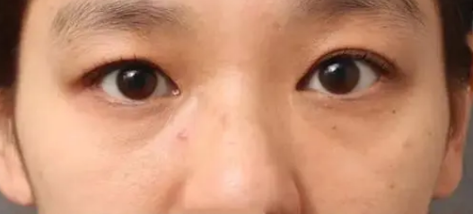 眼袋
