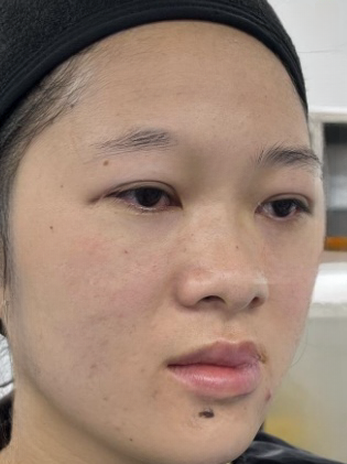 去眼袋手术