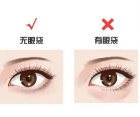 去眼袋手术