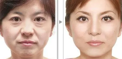 去眼袋手术