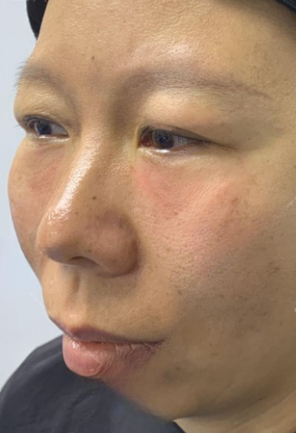 去眼袋手术