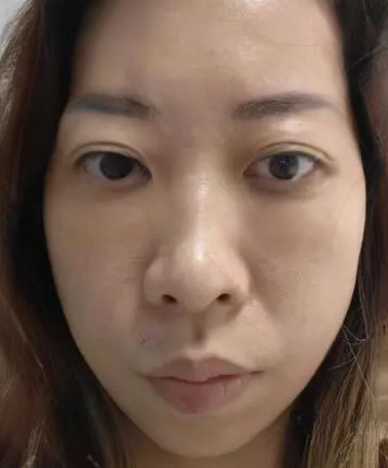 去眼袋手术