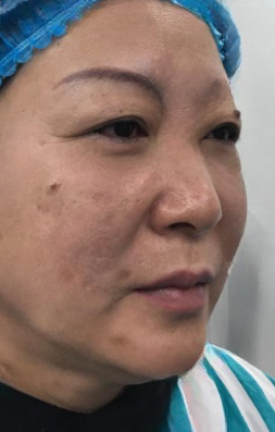 去眼袋手术
