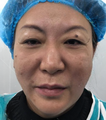 去眼袋手术