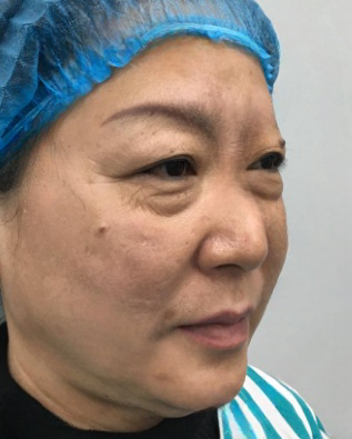 去眼袋手术