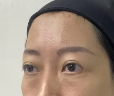 去眼袋手术