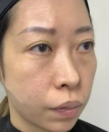 去眼袋手术