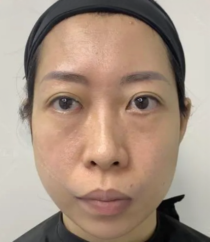 去眼袋手术