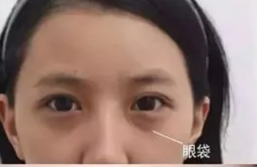 眼袋