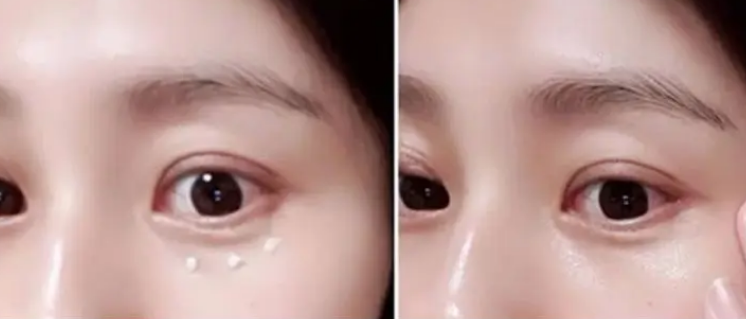 眼袋