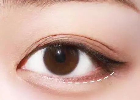 眼袋