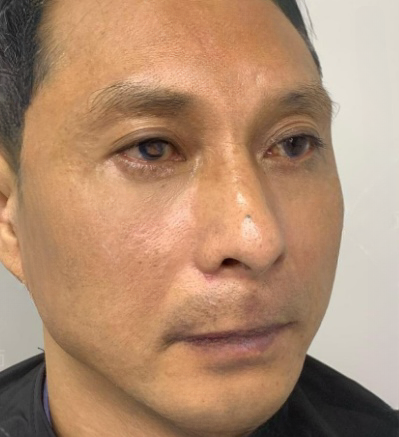 去眼袋手术