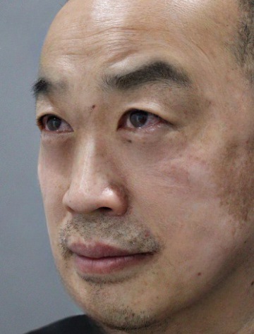 去眼袋手术