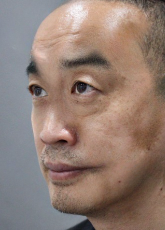 去眼袋手术