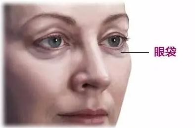 去眼袋手术