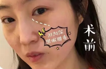 眼袋