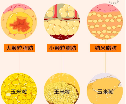 自体脂肪丰胸