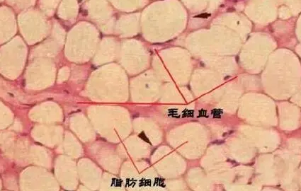 自体脂肪丰胸