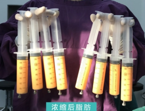自体脂肪丰胸