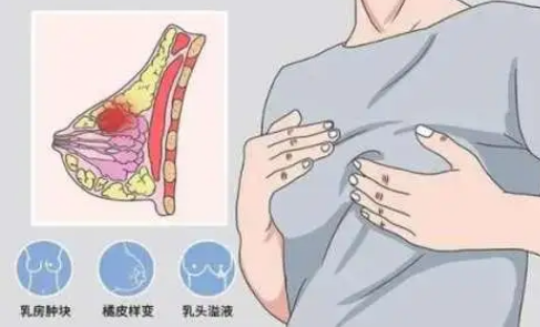 自体脂肪丰胸