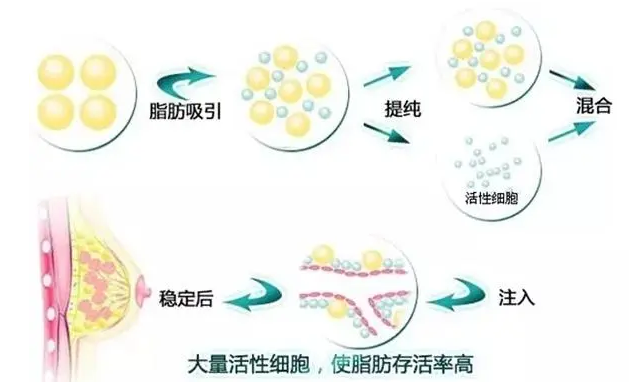 丰胸